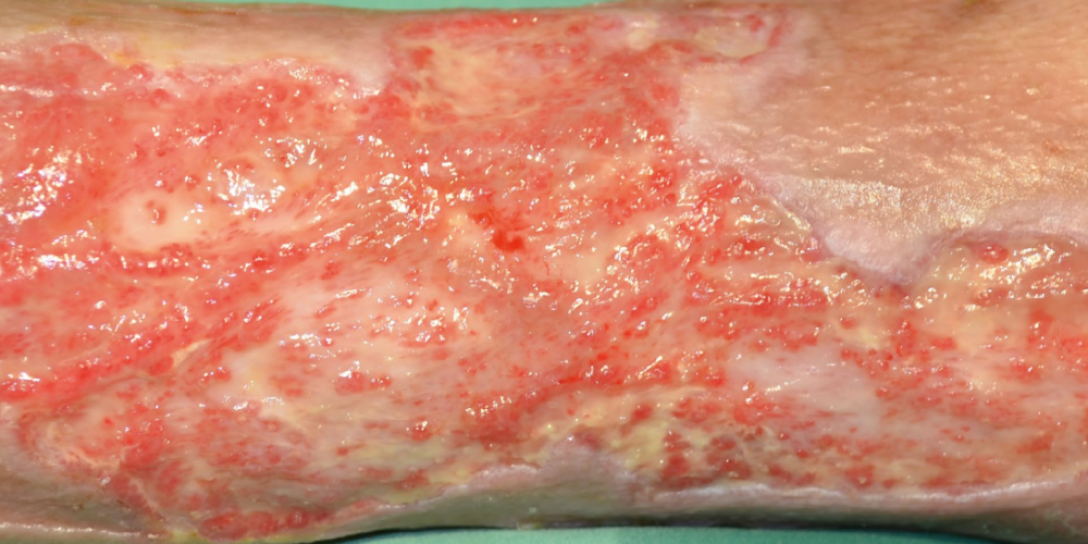 Gamaschenulkus Gamaschenulkus